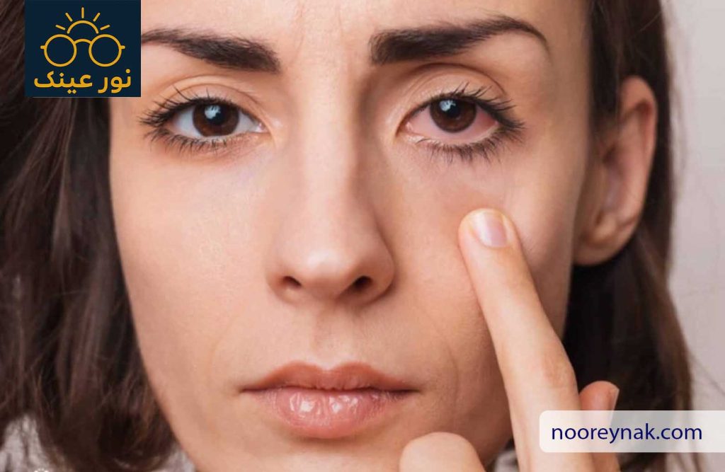 کاهش ورم چشم؛ راهکارهای علمی، خانگی و پزشکی برای درمان سریع و قطعی