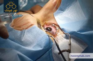 مشاوره جراحی حذف عینک در شهریار