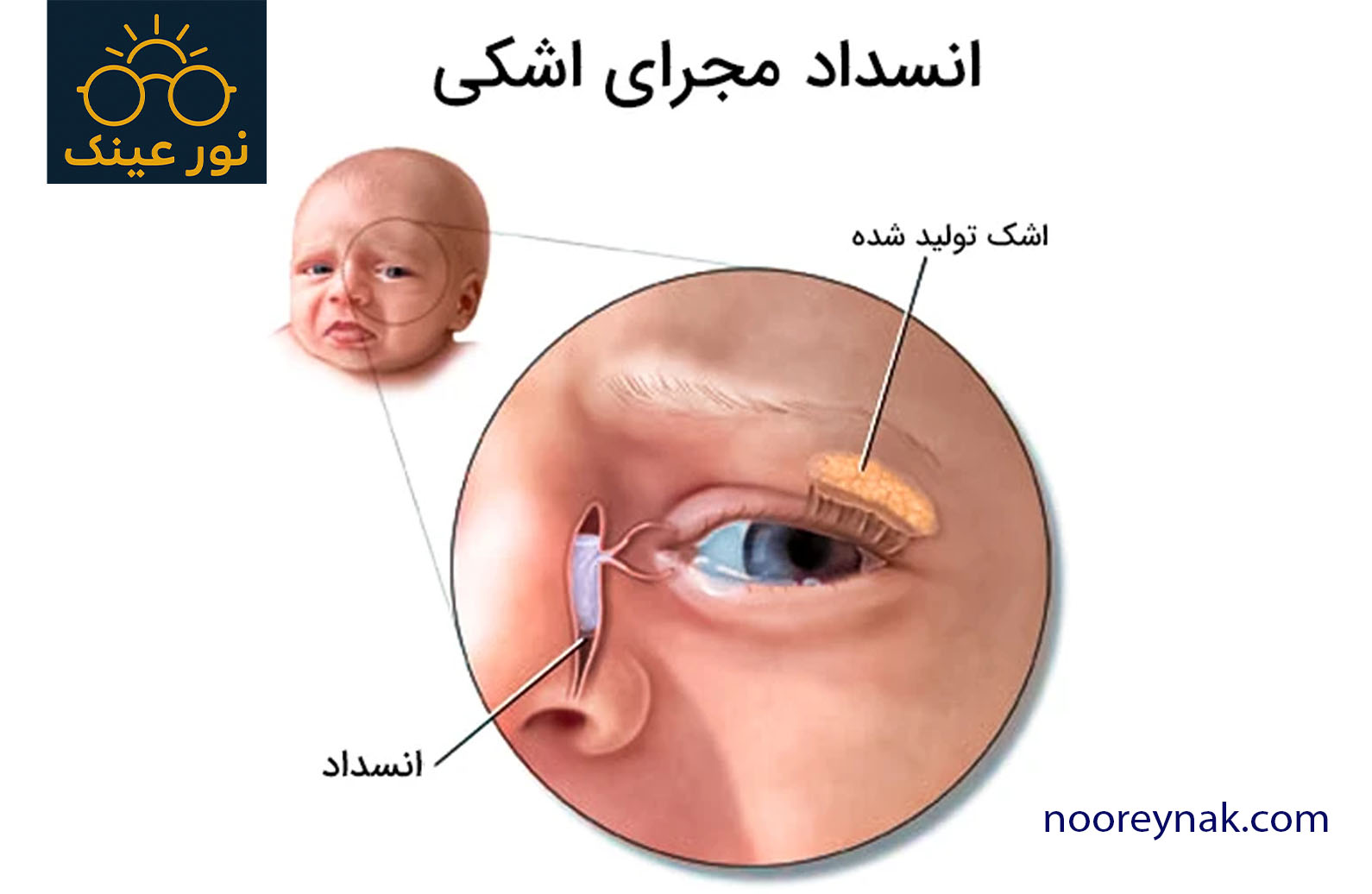 جراحی DCR برای انسداد مجرای اشک